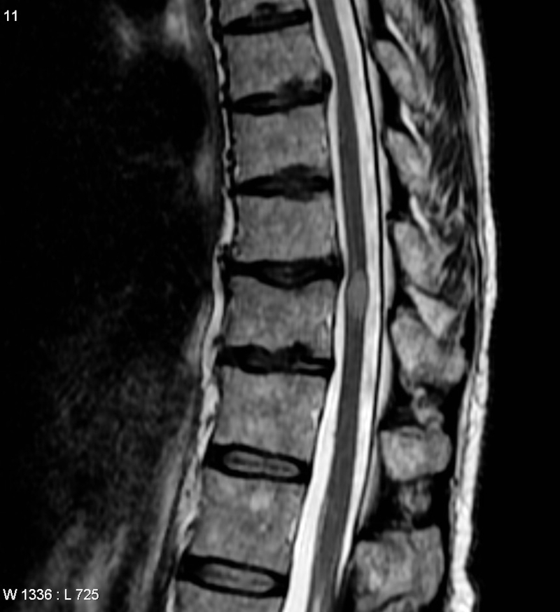 IRM de la moelle épinière présentant une myélite transverse (lésion ovale grisée au centre droit)
