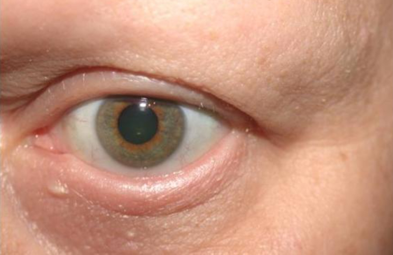 Un oeil sans cils